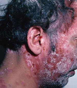 Los absorbentes a la psoriasis